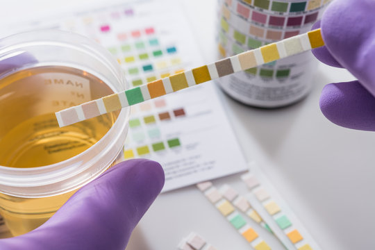 Urine Analysis